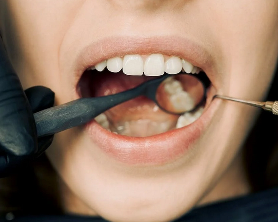 Tooth Infection